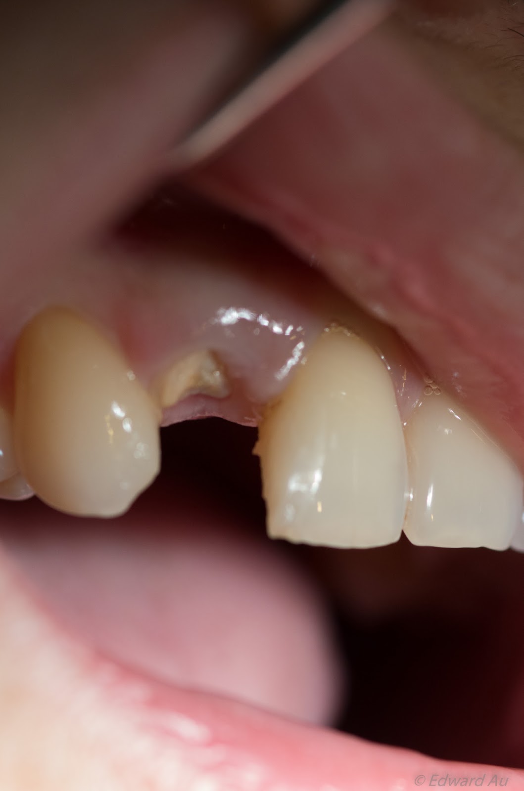 Malaysian Dentist Crowns