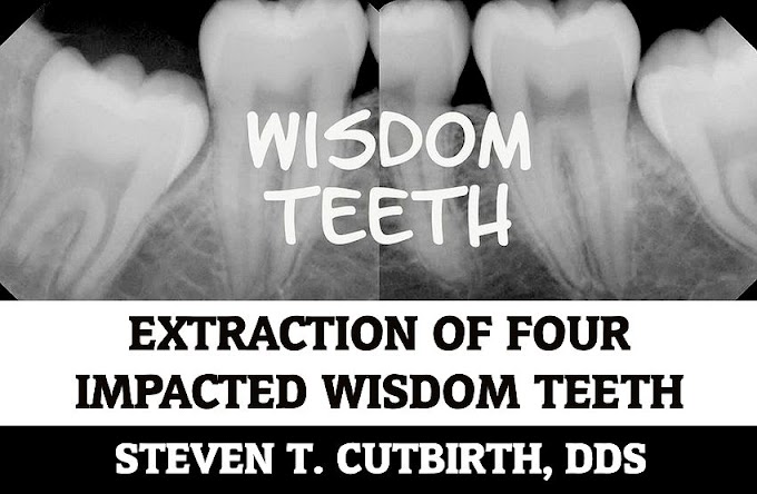 WISDOM TEETH: Extraction of Four Impacted Wisdom Teeth - Steven T. Cutbirth, DDS