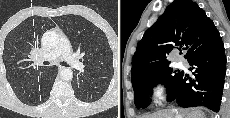 Central pulmonary tumor with vertebral and bilateral suprarenal metastases