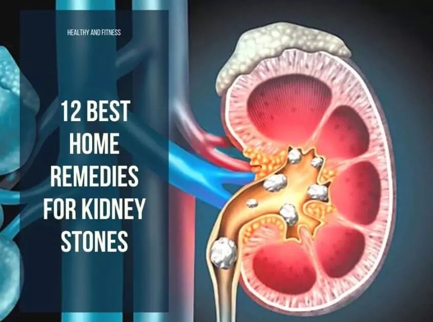 does tamsulosin prevent kidney stones