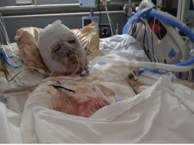 double hand face transplant double hand face transplant