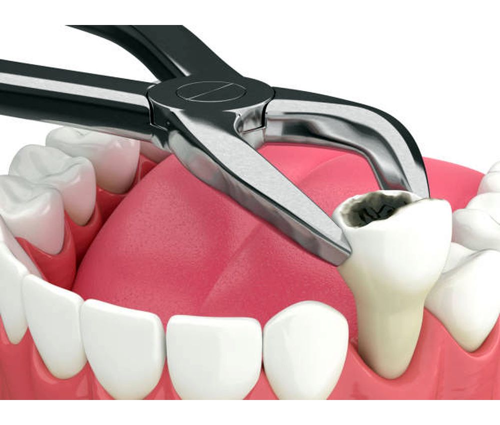 Can a tooth be extracted in diabetic patients? OdontoVida