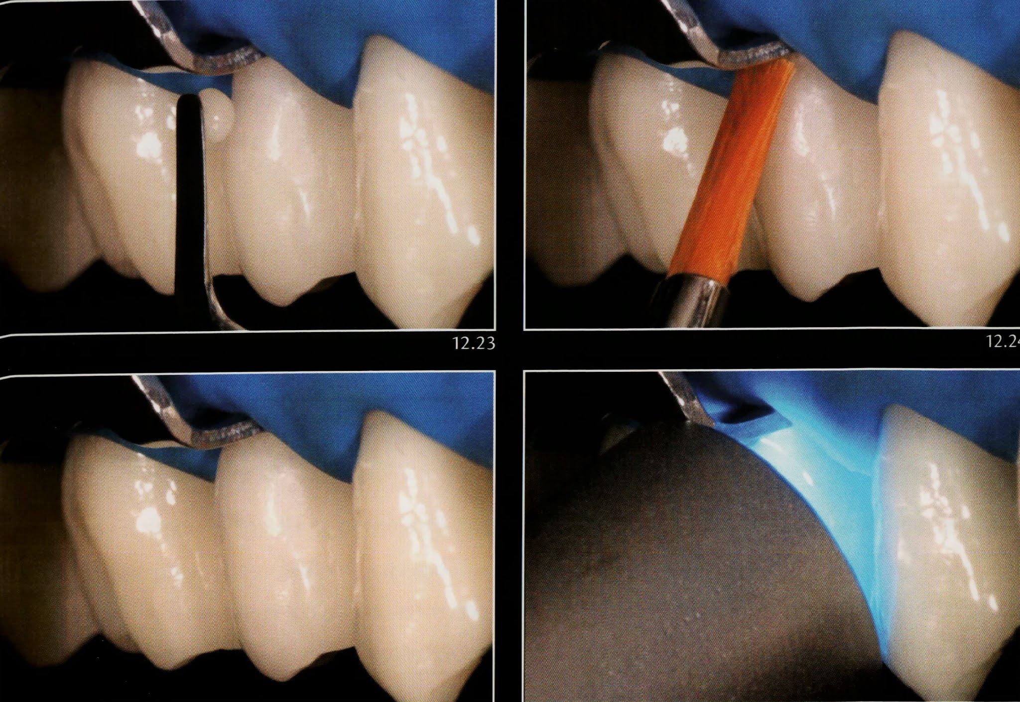 Class V composite restoration " Noncarious lesion " Dental Esthetics