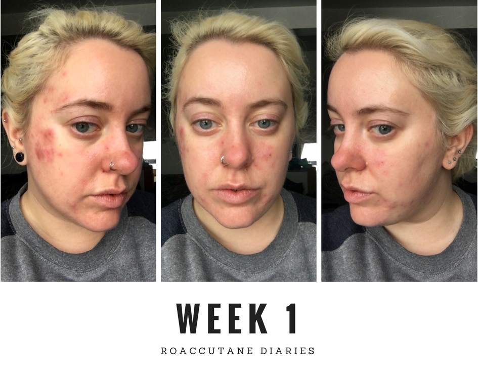 Roaccutane week 1 Roaccutane week 1