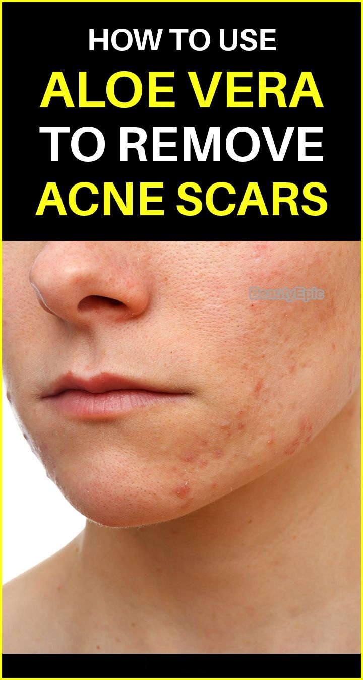 Aloe Vera for Acne and Acne Scars Treatment Natural Beauty Skin Club