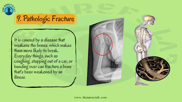 Types of Bone Fracture