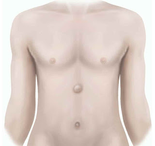 epigastric hernia