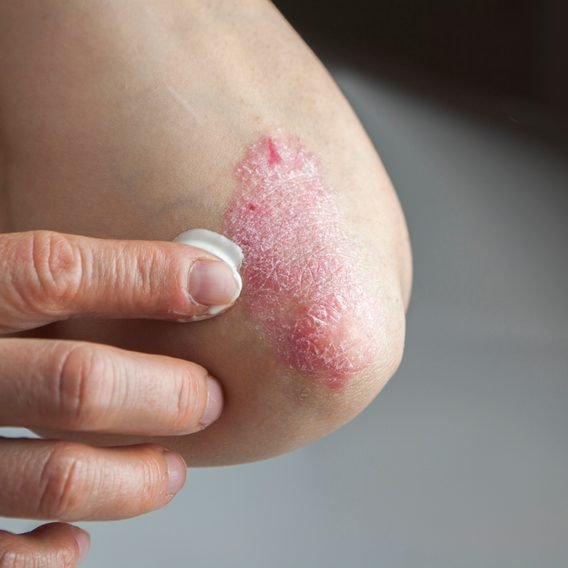 Treating psoriasis with herbs and natural methods