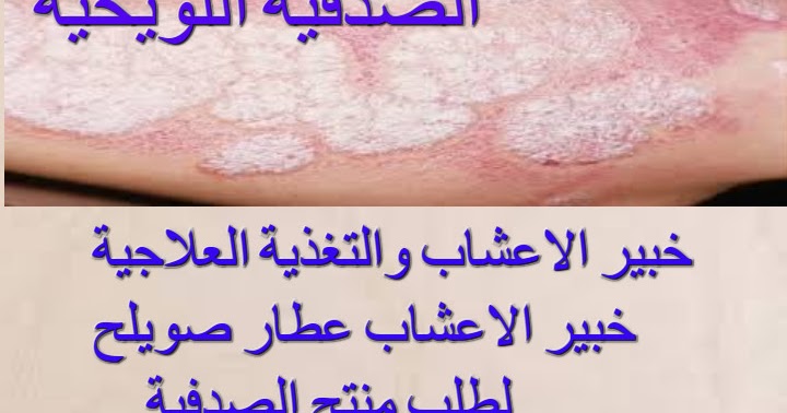 علاج الصدفية والأكزيما بالأعشاب