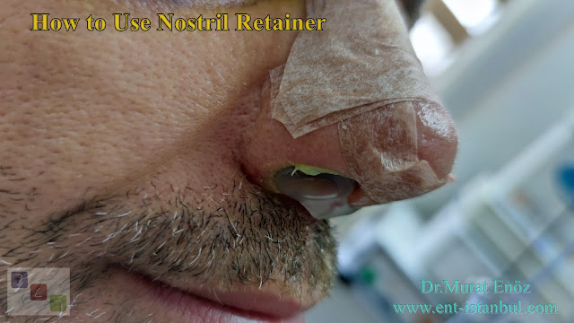 How to Use Nostril Retainer?