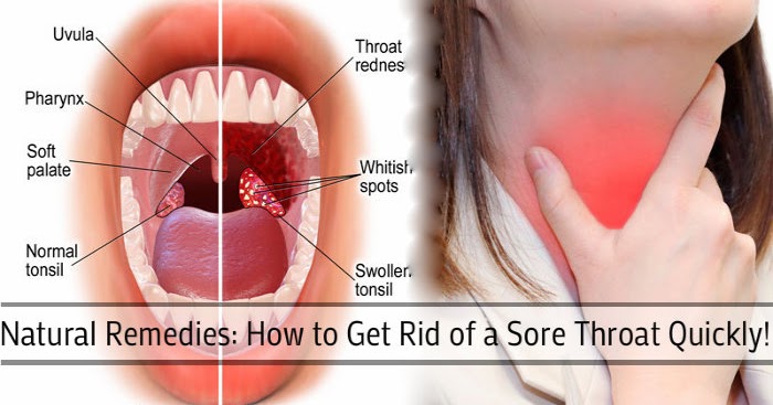 How To Get Rid Of Throat Irritation Naturally How To Get Rid Of Throat Irritation Naturally