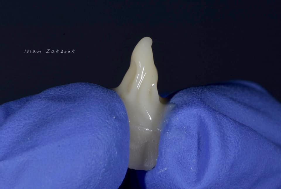 Rehabilitation of a central incisor using pressed ceramic post & core