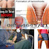 Berak Darah Dan Anus Bengkak Apa Wasir thumbnail
