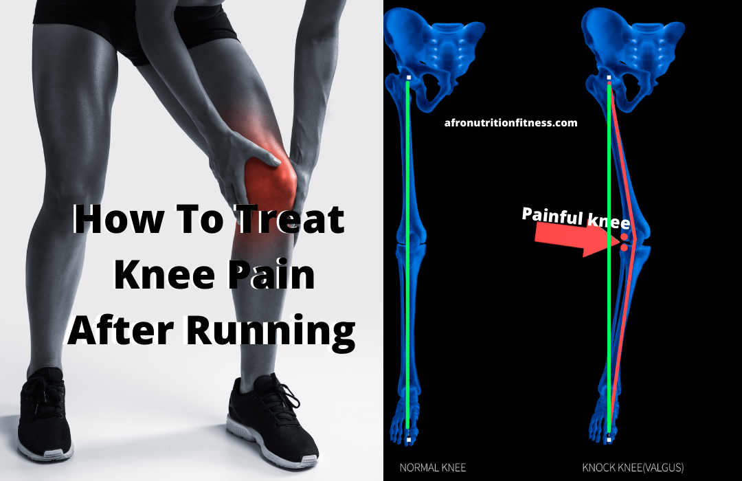 Knee Pain While Running? Here’s 5 Keys To Treat Knee Pain After Running