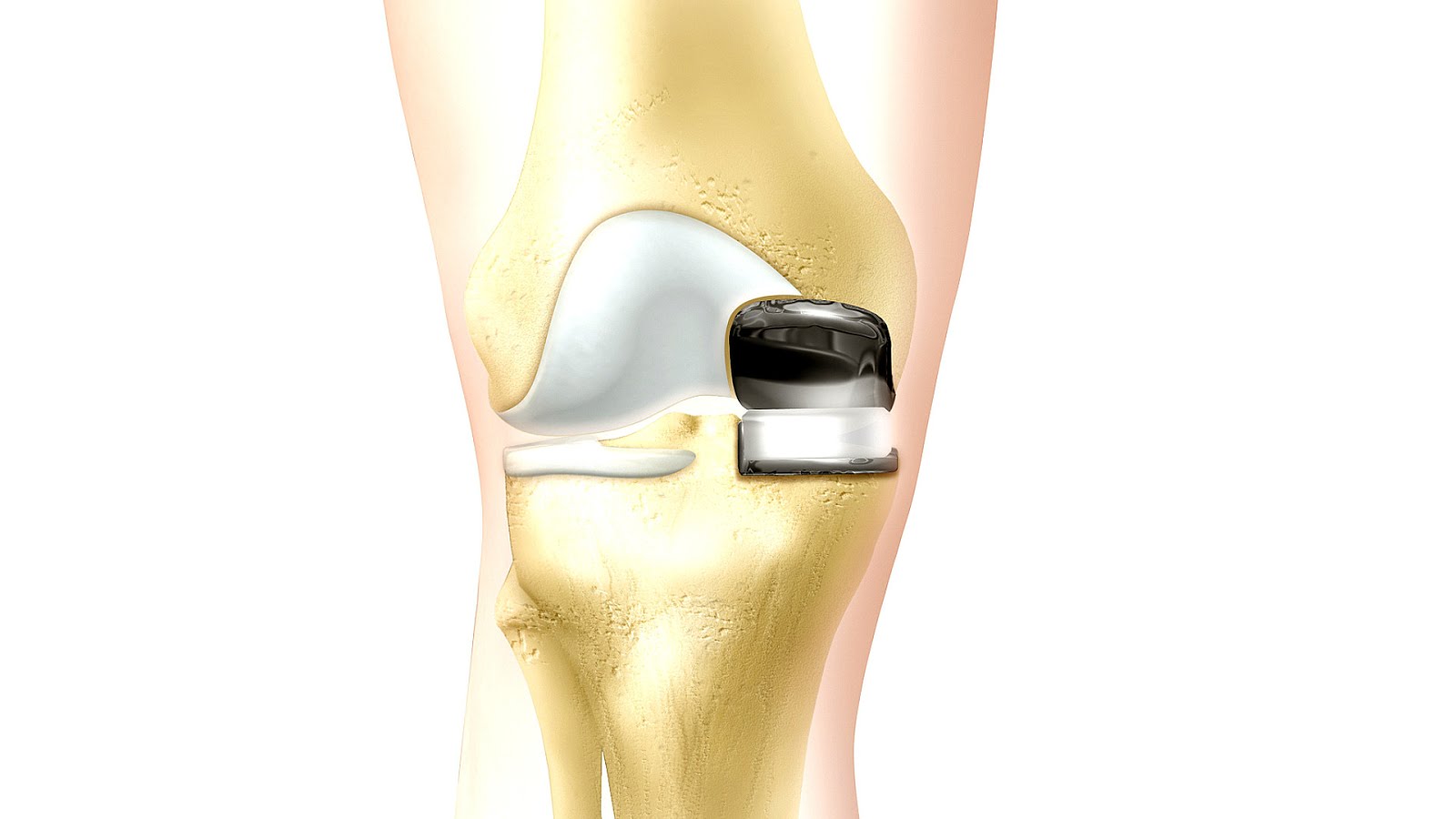 Problems after knee surgery
