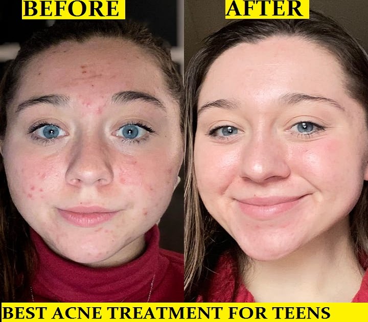 Best Acne Treatment For Teens Finding the Best Acne Treatment For Your Troubled Skin