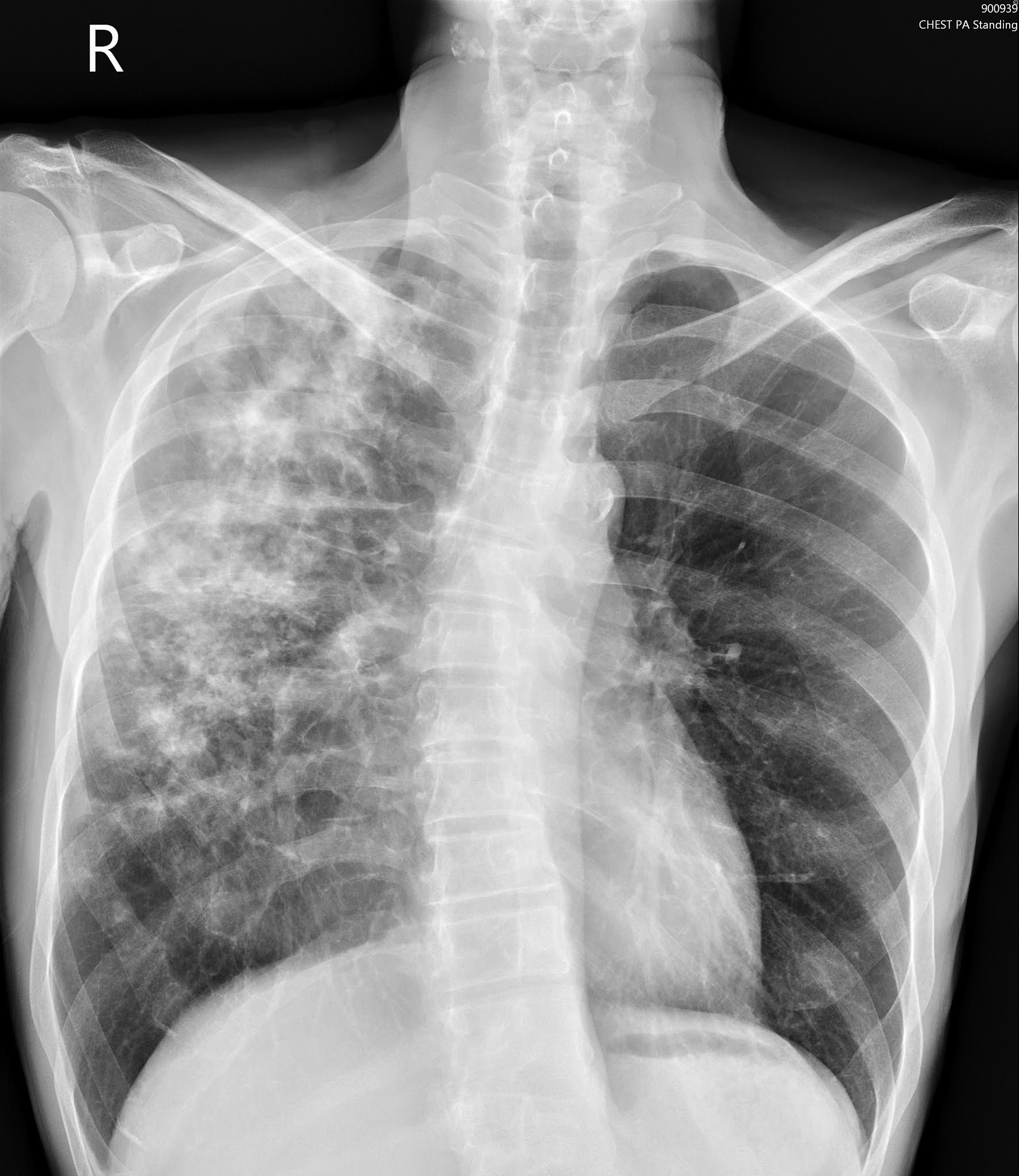 Tensorflow2.0 医学图像分类(X光胸片肺炎图像诊断) - 肺部胸片图片 - 实验室设备网