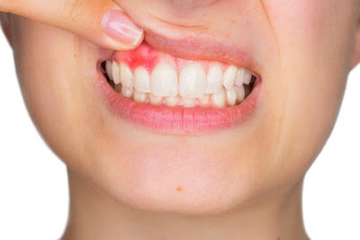 Cách điều trị viêm chân răng 