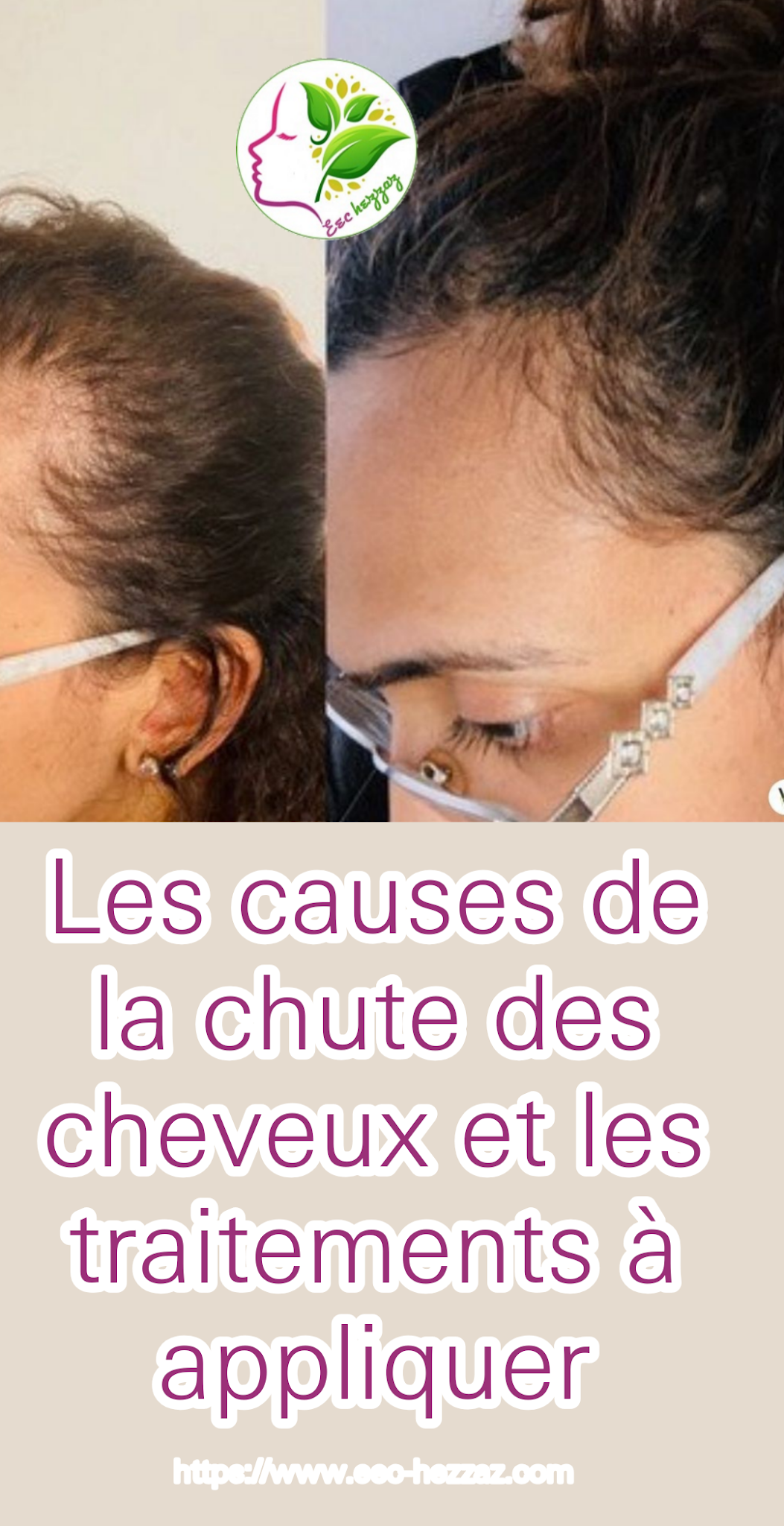 Les causes de la chute des cheveux et les traitements à appliquer