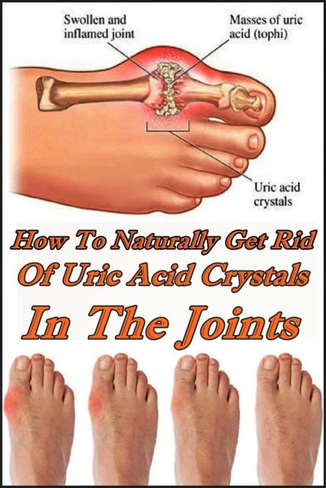 How To Naturally Get Rid Of Uric Acid Crystals In The Joints | Remedy Day