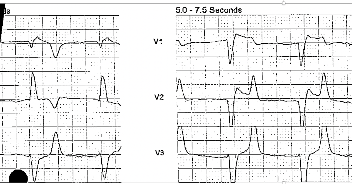 Dr. Smith's ECG Blog Bradycardia, Crushing Chest pain, and Pulseless