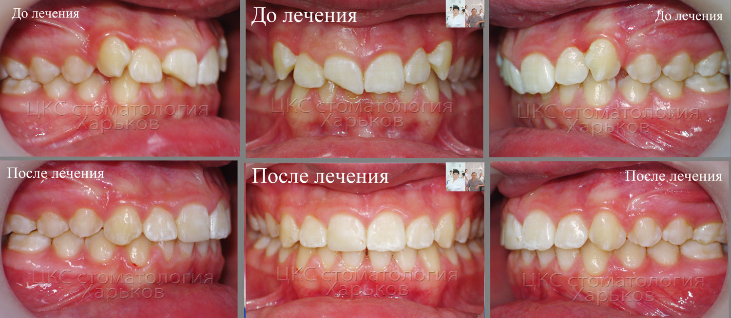 О стоматологии и не только...: Есть скол зуба после травмы. Лечение ...