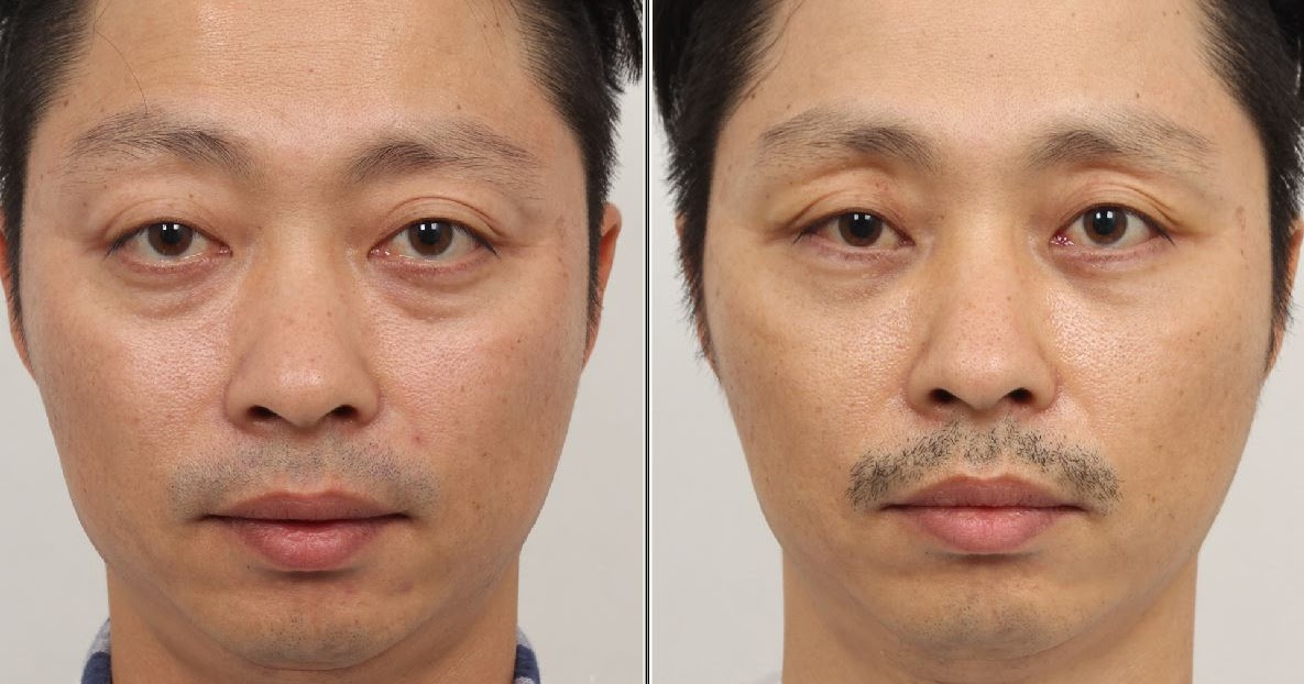 EFIL Bulging Eyes Plastic Surgery JCI Do you have bulging eyes? Want