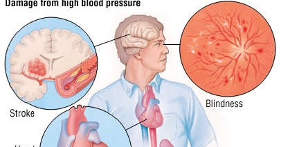 hypertension meaning in hindi egészség megnöveli a szívet