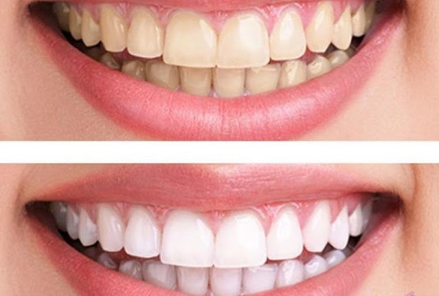 وصفات طبيعية لتبييض الأسنان وإزالة التصبغات | Natural recipes for teeth whitening and pigmentation