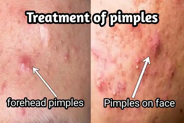 The causes for appearance of pimples on the face and treatment appearance of pimples on the face