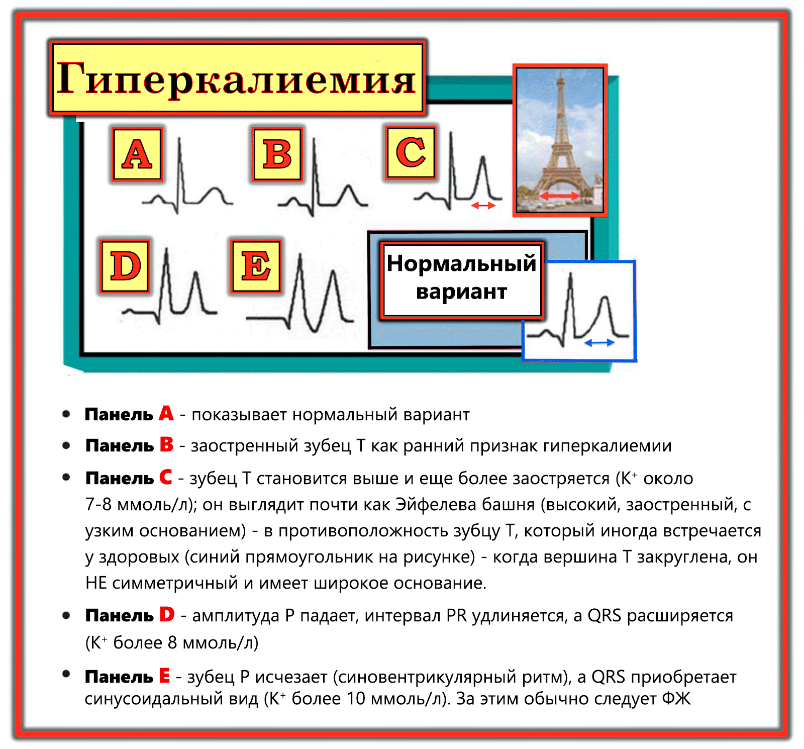 Гиперкалиемия причины и клинические проявления. Гиперкалиемия экг на экг. Гиперкалиемия лекарства. Гиперкалиемия симптомы. Проявления гиперкалиемии.