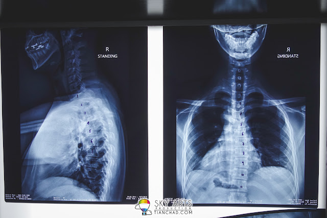 My X-Rays showing signs of distorted backbone