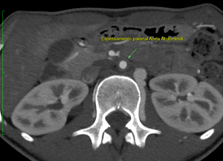BLOG SCAN RA Radiologistas Associados ARTERITE DE TAKAYASU