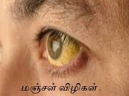 yellow eye for jaundice eyes