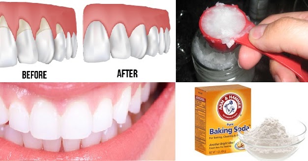 6 Natural Ways To Stop And Heal Receding Gums Before It's Too Late ...