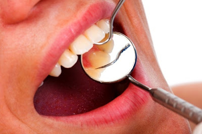 Cách chữa viêm lợi chân răng hiệu quả tại nhà-1