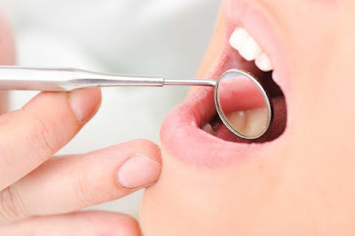 Tìm ra các nguyên nhân gây sưng nướu răng hàm trên 1