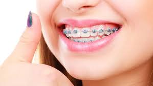 افضل عيادة تركيب تقويم اسنان في جدة orthodontics  , 2022