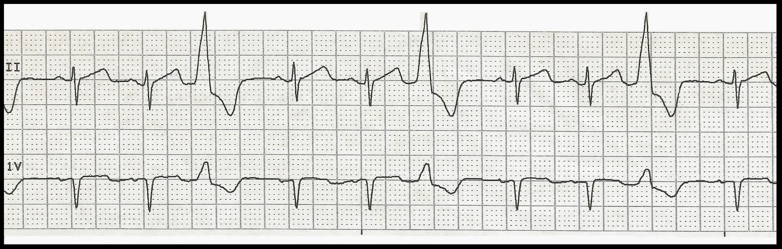 Practice EKG Rhythm Strips 225