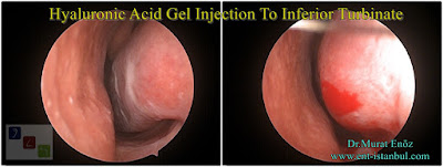 Hyaluronic Acid Gel Injection To Inferior Turbinate