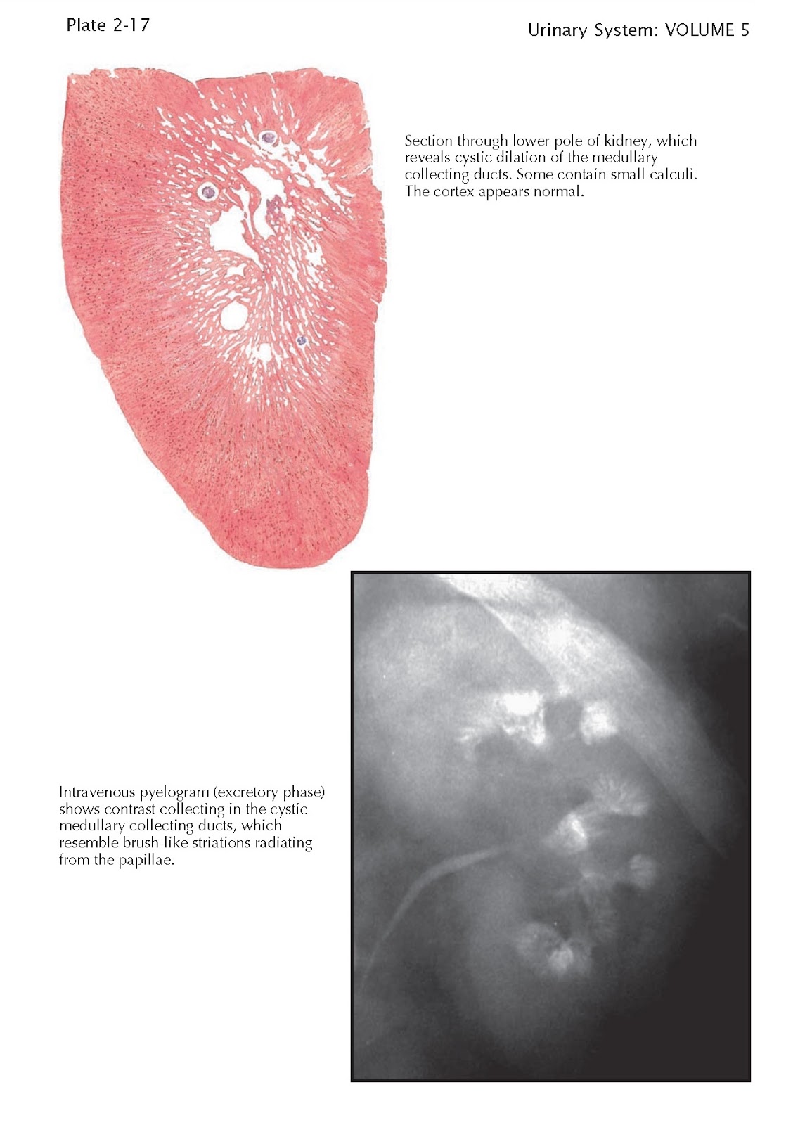 MEDULLARY SPONGE KIDNEY pediagenosis