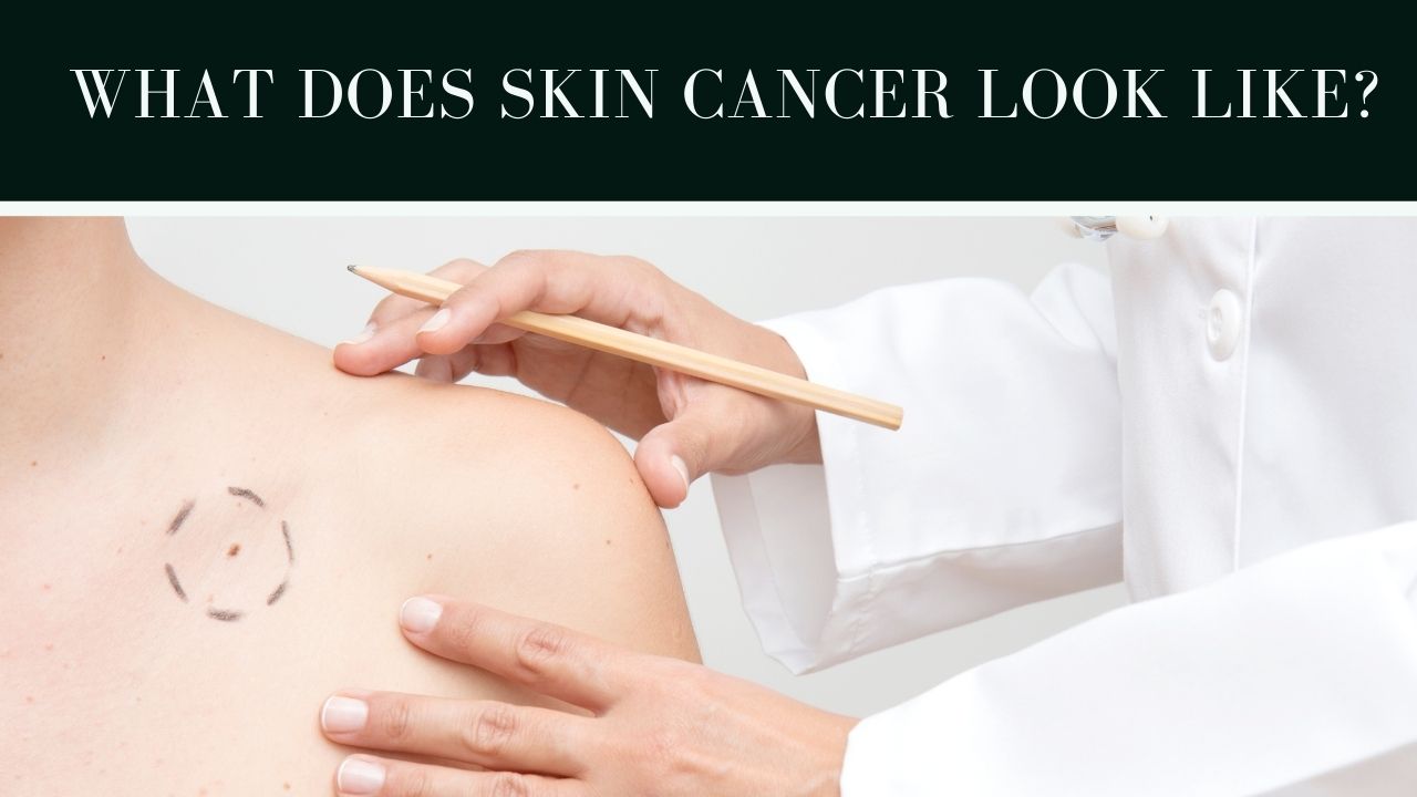 skin-cancer-types- causes-symptoms-pictures