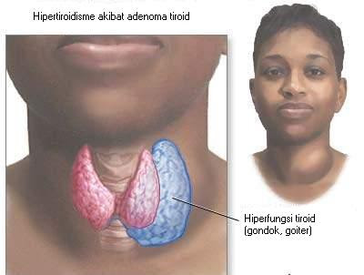 adenoma tiroid