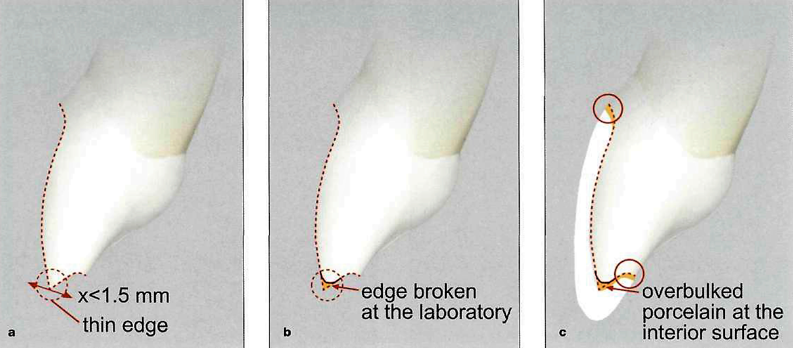 Ceramic veneers preparartion .. Part 1 Dental Esthetics