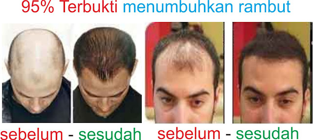 penumbuh%2Brambut%2Bmencegah%2Bkebotakan%2Brambut%2Bsubur.jpg