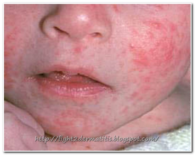 All About Dermatitis in Babies | Let us Fight To DERMATITIS