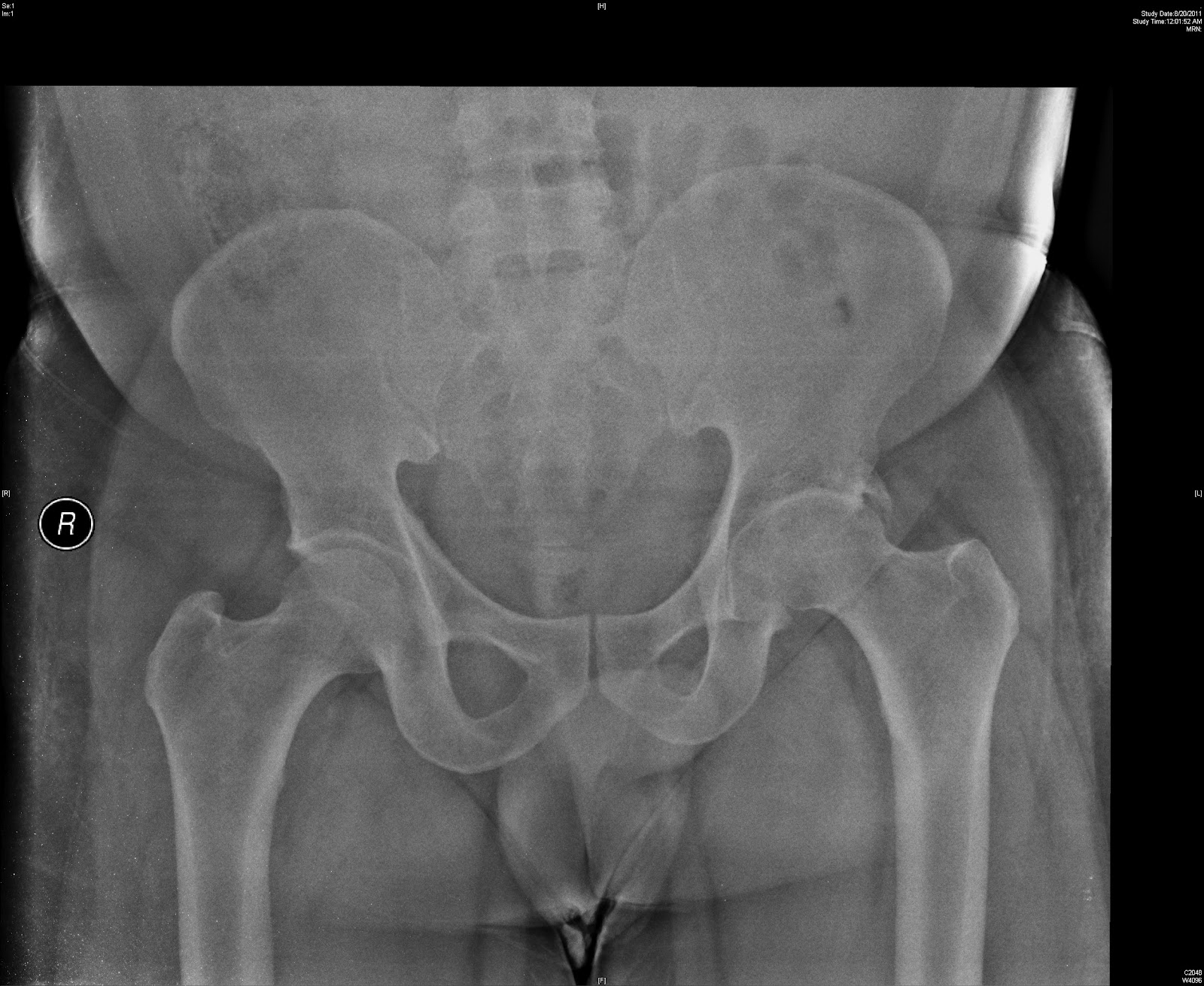 a fractured hip a fractured hip