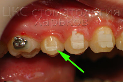 Осложнение лечения. Отклеивание брекета