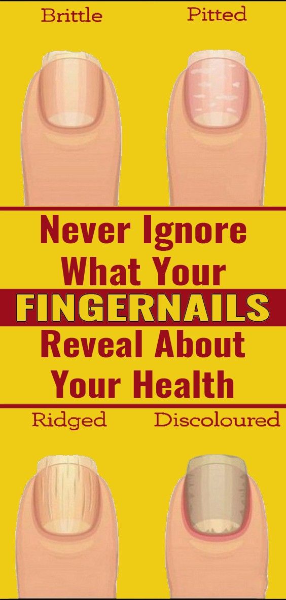 8 Important Signs Your Fingernails Can Tell About Your Health