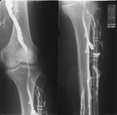 Pulmonary Embolism Diagnosis ~ akufisio.blogspot